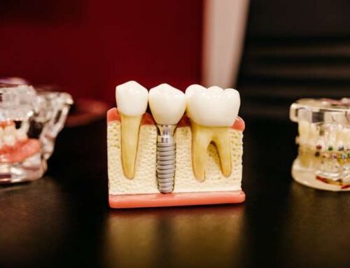 Dental Implants or Dentures: Which is Right for You?