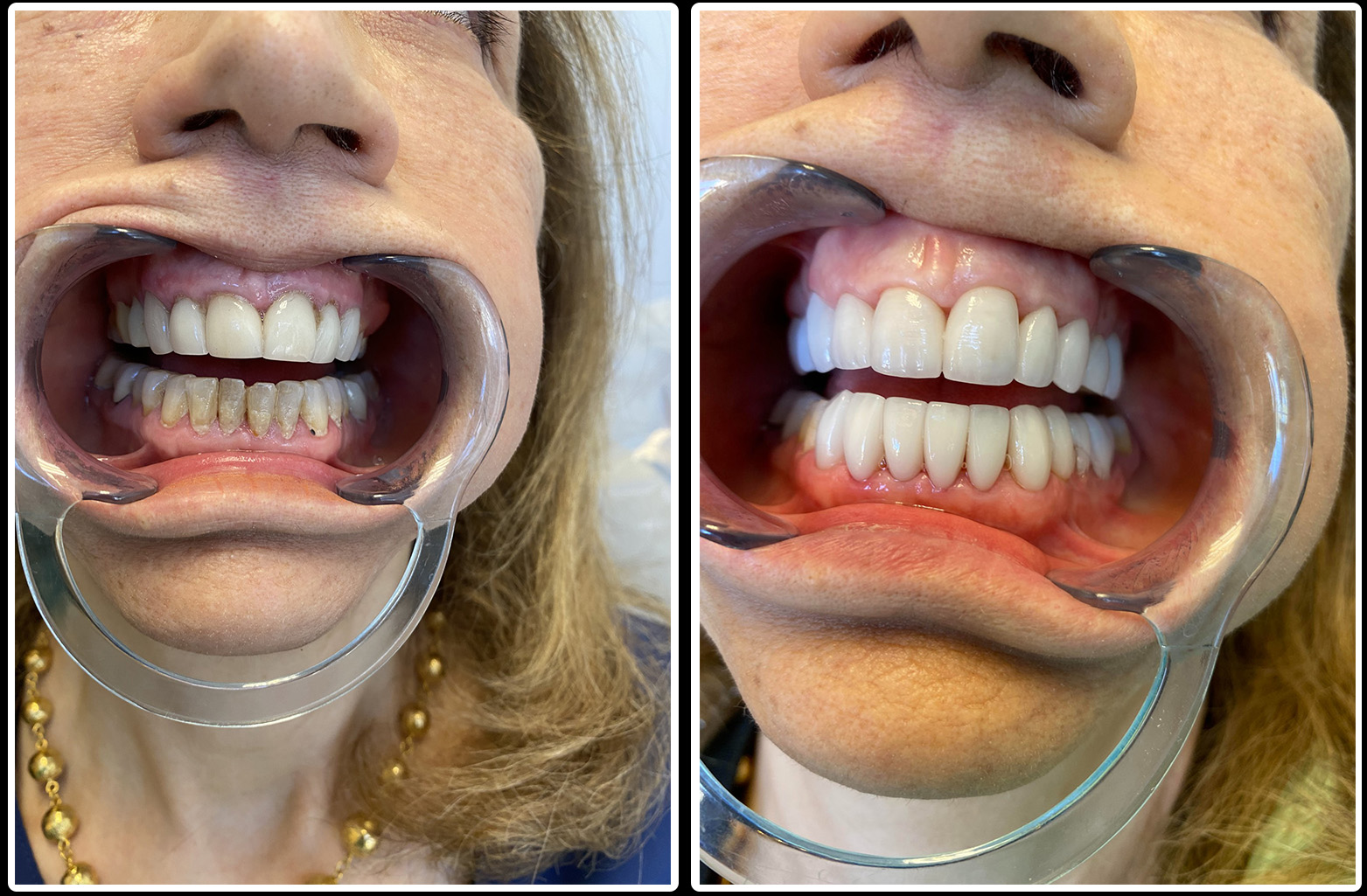 before and after look at patients teeth