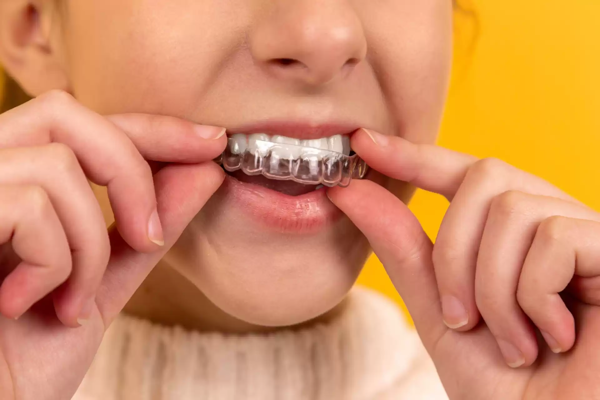 A young woman inserting an invisalign retainer into her mouth