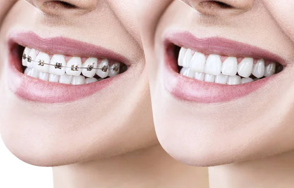 person with braces before after
