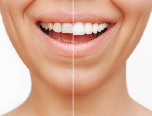 How Dental Veneers Can Improve Your Smile