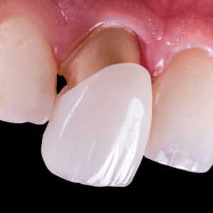 close up of dental veneer on tooth