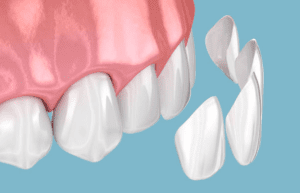 dental veneers visualization