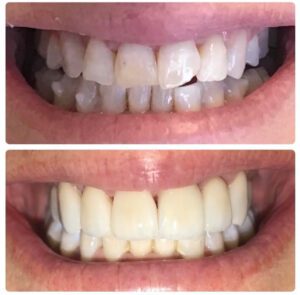 Cosmetic Dentistry before and after shot from Sierra Dental Practice