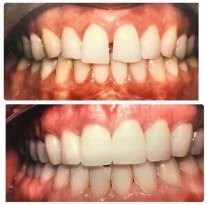 Teeth alignment before and after shot from Sierra Dental Practice