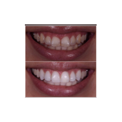 porcelain veneers before and after