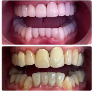 smile makeover before and after shot from Sierra Dental Practice