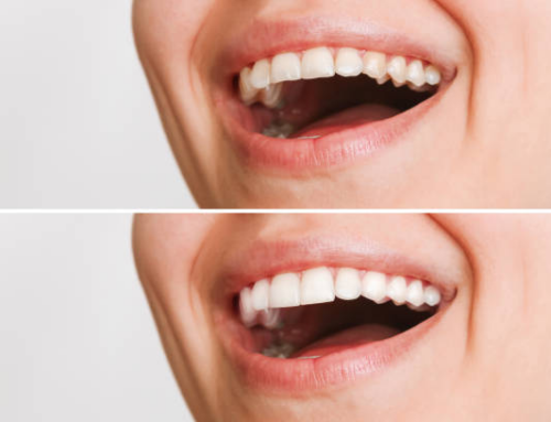 Smile Makeovers: Top Appearance Problems Veneers Can Fix