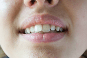 Crooked Misaligned Teeth