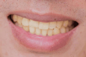 Stained Discolored Teeth