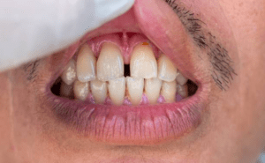 gaps between teeth